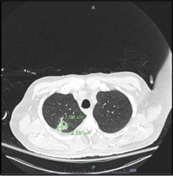 Figure 4: Axial Chest CT without Contrast (August 2025). Dominant index right lower paratracheal lymph node measuring 2.5 x 2.1 cm.