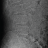 Post-operative Microdiscectomy Complicated by Lumbar Epidural Hematoma with Cauda equina Syndrome Following Dual Viral Infection: A Rare Case Report and Its Management