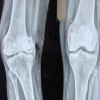 Non-union Hoffa’s fracture in an Adult Male managed with Total Knee Arthroplasty : A Rare Case Report