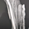 Management of Infected Non-union of Long Bones Using Antibiotic Cement-Coated Intramedullary Nails: A Prospective Case Series