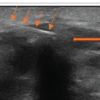 Thoracolumbar Fascial Defect in Persistent Low Back Pain After Lumbar Surgery: Ultrasound Findings and Response to Fascial Plane Injection