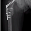 Bisphosphonate-Related Pathological Femoral Fracture in a Child with ACTG2-Related Intestinal Failure and Metabolic Bone Disease: A Case Report