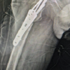 Functional Outcomes of Valgus Osteotomy in Young Patients of Intracapsular Neck of Femur Fracture: A Case Series