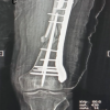 Dual Fixation in Complex Long Bone Fractures: A Case Series of 30 Patients