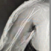 Outcome of Retrograde Titanium Elastic Nailing System in Shaft of Humerus Fractures: A Case Series