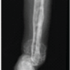 Extensive Giant Cell Tumor Involving Entire Tibia with Talar Extension and Pulmonary Metastases: Successful Limb Preservation with Denosumab and Angioembolization
