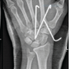 Volar Carpometacarpal Dislocation Associated with Fracture of the Second, Third, and Fourth Metacarpal Bases Treated by Closed Reduction and Percutaneous Fixation: A Case Report