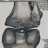 Clinical and Functional Outcomes of Posterior Cruciate Ligament Tibial Avulsion Fractures Treated with a Mini-Open Posterior Approach and Internal Fixation: A Case Series