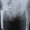 A case of central migration of a prosthetic femoral head following bipolar hemiarthroplasty treated with conversion to total hip arthroplasty using an acetabular reinforcement ring