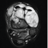 Low-Grade Myxofibrosarcoma of the Leg Presenting as a Pathological Pilon Fracture: A Case Report