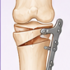 Arthroscopic Repair of Meniscal Medial Root Tears: The Necessity of Concomitant Realignment Osteotomy