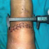 Functional and Cosmetic Outcome in Vertical Midline versus Horizontal Curvilinear Patella-Centered Incision in Internal Fixation of Patellar Fractures