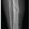 Predictors of Delayed Union Following Locking Compression Plate Fixation of Tibial Shaft Fractures: A Prospective Observational Study