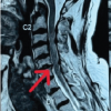 Post-operative C5 Palsy Following Posterior Cervical Decompression and Fusion: A Case Report