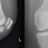 Arthroscopic Piecemeal Excision of a Large Intra-articular Infrapatellar Osteochondroma of the Knee: A Case Report