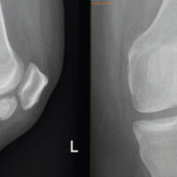 Figure 1: Left knee radiograph showing calcified mass in the infrapatellar region.