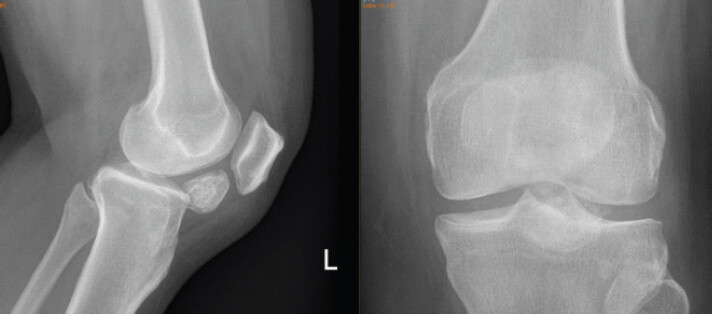 Figure 1: Left knee radiograph showing calcified mass in the infrapatellar region.