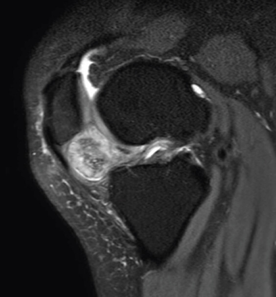 Figure 2: Sagittal image of magnetic resonance imaging of the knee showing the well-calcified mass surrounded by cartilage cap.