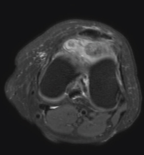 Figure 3: Axial section of the magnetic resonance imaging left knee demonstrating the same lesion.