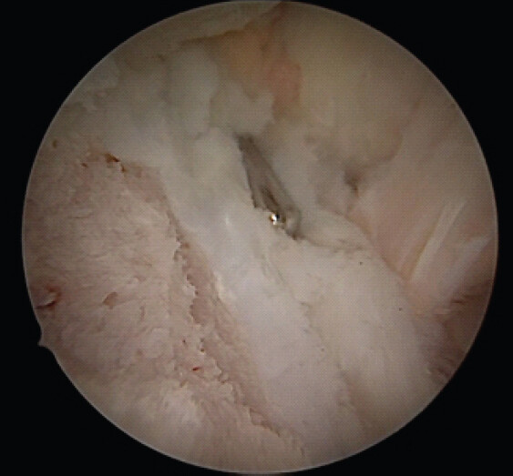 Figure 5: Arthroscopic view after piecemeal partial excision. Ossified core on the left with cartilage cap surrounding it.