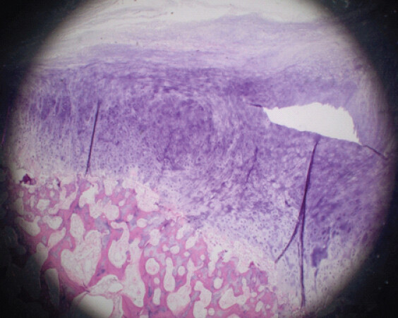 Figure 6: Osteochondroma with hyaline cartilaginous cap and underlying lamellar bone trabeculae with interface of enchondral ossification hematoxylin and eosin ×1.25 infrapatellar fat pad to be excised arthroscopically in the published literature.