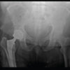 Undiagnosed von Willebrand Disease Presenting as Delayed Hematoma after Total Hip Arthroplasty: A Case Report