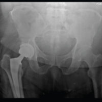 Figure 1: Post-operative anteroposterior pelvis radiograph before hematoma evacuation, showing a well-positioned right total hip arthroplasty without dislocation, periprosthetic fracture, or hardware failure. Increased soft-tissue density and surgical staples are noted over the right gluteal and posterior thigh region.