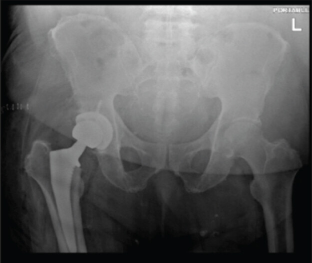 Figure 1: Post-operative anteroposterior pelvis radiograph before hematoma evacuation, showing a well-positioned right total hip arthroplasty without dislocation, periprosthetic fracture, or hardware failure. Increased soft-tissue density and surgical staples are noted over the right gluteal and posterior thigh region.