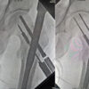 Retrieval of a Broken Cannulated Drill Bit from the Femoral Neck during Proximal Femoral Nailing: Case Report of a Novel Lever Technique Using a Depth Gauge