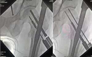 Figure 1: Fractured drill bit at mid-shaft, leaving the distal portion lodged within the reamed canal in the femoral neck. Intraoperative fluoroscopic image showing the fractured 8-mm cannulated drill bit with the distal fragment lodged within the femoral neck during proximal femoral nailing. The retained fragment lies along the compression-screw trajectory and necessitates retrieval to permit optimal implant positioning.