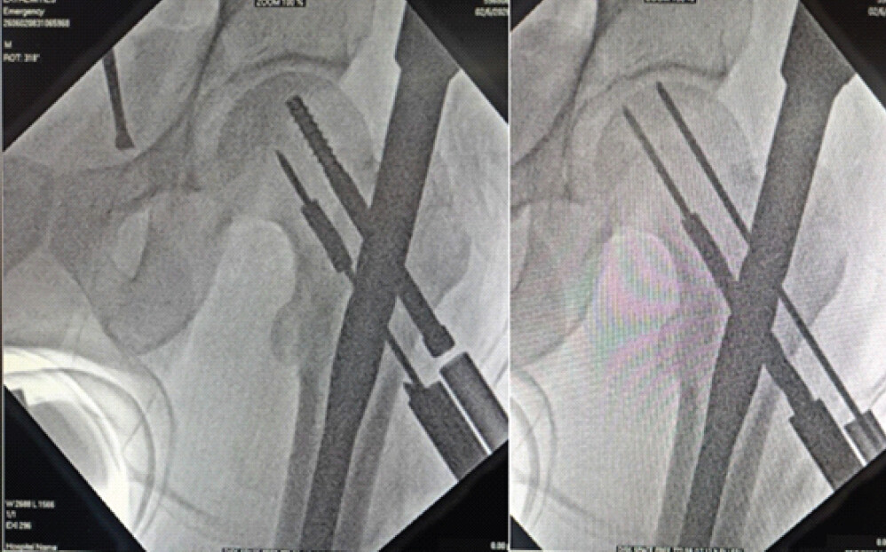 Figure 1: Fractured drill bit at mid-shaft, leaving the distal portion lodged within the reamed canal in the femoral neck. Intraoperative fluoroscopic image showing the fractured 8-mm cannulated drill bit with the distal fragment lodged within the femoral neck during proximal femoral nailing. The retained fragment lies along the compression-screw trajectory and necessitates retrieval to permit optimal implant positioning.