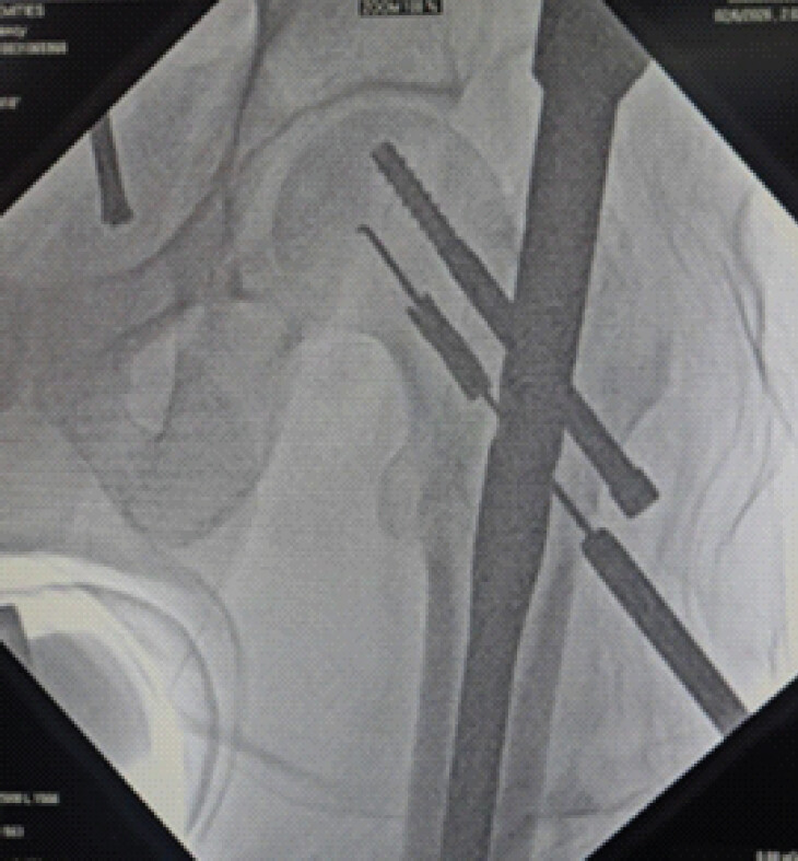 Figure 2: Engaging depth gauge with the broken drill bit. Intraoperative fluoroscopic images demonstrating advancement of the hooked depth gauge through the cannulation of the retained broken drill bit. The hooked tip is passed beyond the distal end of the fragment under fluoroscopic guidance and rotated axially so that its hooked tip was oriented to face medially and to facilitate mechanical engagement.