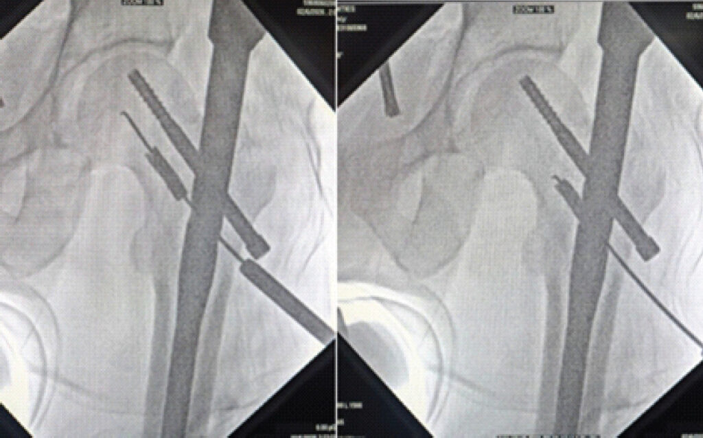 Figure 3: Performing the lever maneuver with depth gauge. Intraoperative fluoroscopic images demonstrating the depth-gauge lever maneuver used for retrieval of the broken drill-bit fragment. The hooked tip is engaged with the inner surface of the fragment, allowing controlled extraction through the proximal femoral nail.