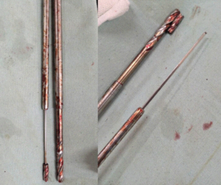 Figure 4: Intraoperative picture of broken drill bit post-retrieval. Intraoperative photograph demonstrating the retrieved broken 8-mm cannulated drill bit alongside the depth gauge used for its extraction. The intact cannulated drill bit is shown for comparison.