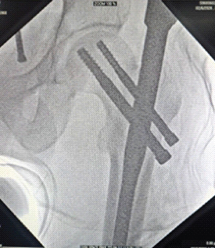 Figure 5: Final intraoperative C-arm image of completed procedure post-retrieval. Intraoperative fluoroscopic image following retrieval of the broken drill bit, demonstrating restoration of the compression-screw trajectory and satisfactory positioning of the proximal femoral nail and cephalon-cervical screws.