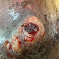 Figure 1: Non- healing ulcer on right cheek. Clinical photograph of the right facial region displaying a fungating, exophytic metastatic tumor eroding through the cutaneous layer of the cheek, demonstrating central ulceration, focal necrosis, and active capillary hemorrhage.
