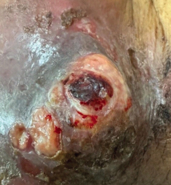 Figure 1: Non- healing ulcer on right cheek. Clinical photograph of the right facial region displaying a fungating, exophytic metastatic tumor eroding through the cutaneous layer of the cheek, demonstrating central ulceration, focal necrosis, and active capillary hemorrhage.