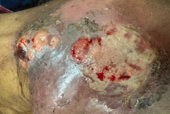 Figure 2: Non-healing ulcer on right cheek. Extended oblique view of the maxillofacial lesion illustrating extensive cutaneous infiltration, slough-covered necrotic beds, and peripheral tissue edema resulting from rapid cortical breach of the underlying mandibular body.