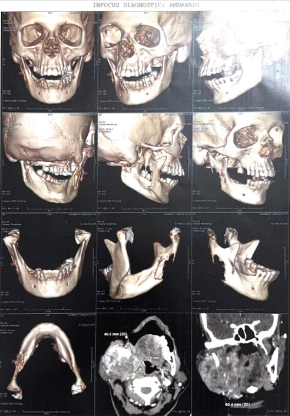 Figure 3: Computed tomography mandible. Reconstructed 3D and axial computed tomography scans of the mandible. The 3D render demonstrates a severe, osteolytic, destructive lesion centered at the right mandibular angle and ramus with total cortical destruction, creating an impending pathological fracture risk. The axial soft-tissue cuts confirm a massive bicortical mass measuring 59.6 × 40.5 mm in cross-section with pharyngeal space compromise.