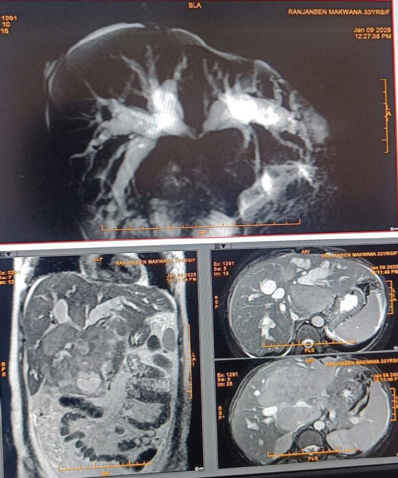 Figure 4: Triple phase magnetic resonance imaging abdomen. Triple-phase abdominal magnetic resonance imaging. Coronal and axial contrast-enhanced images demonstrate a large, multi-lobar hypervascular intrahepatic tumor in the left liver lobe with classical arterial enhancement and venous phase wash-out (LI-RADS 5), underlying background cirrhosis, dilated intrahepatic bile ducts, and an invasive left portal vein tumor thrombus.
