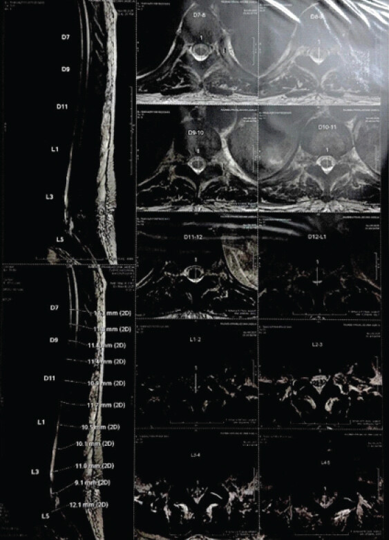 Figure 5: Magnetic resonance imaging (MRI) spine. Sagittal and axial T2-weighted and T1-contrast 3T MRI of the dorso-lumbar spine. Images depict focal altered signal intensity within the left pedicle, lamina, and posterior elements of the L3 vertebra, accompanied by facet joint effacement and diffuse posterior disc protrusions causing thecal sac compression.