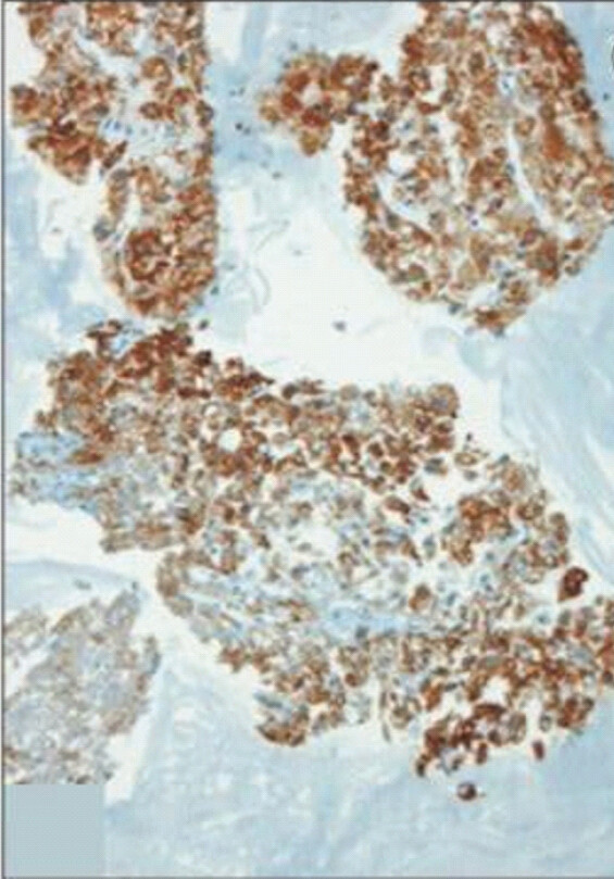 Figure 6: Tumor cells stained for Hepar-1 antibody. Immunohistochemical findings suggest that the tumor cells stained for Hepar-1 antibody (×200) are proof of hepatocyte.