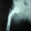 Fracture of the cemented femoral component following hemiarthroplasty in physically active patient: A case report