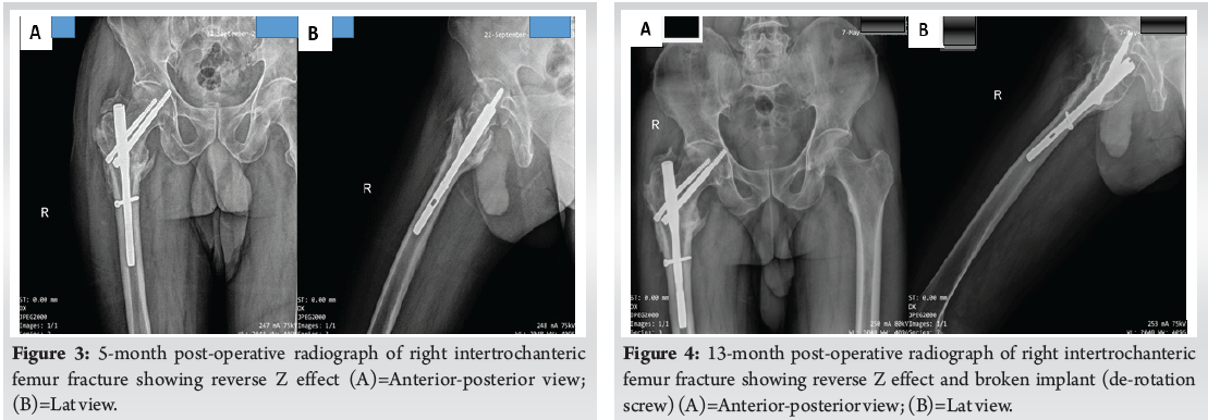 Healing Against the Odds: Successful Bone Union in Intertrochanteric ...