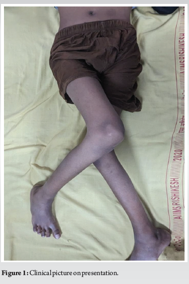 Bilateral Traumatic Posterior Hip Dislocation – A Case Report | Journal ...