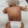 Congenital Asymmetrical Multiple Limb Deficiency in 1-Year-Old Male Child: A Case Report