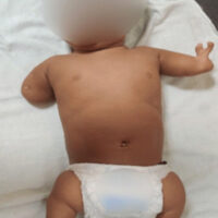 Figure 1: Clinical photograph showing congenital limb deficiencies involving both upper and lower limbs.