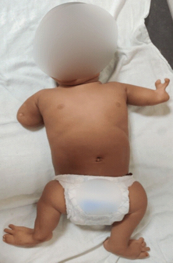 Figure 1: Clinical photograph showing congenital limb deficiencies involving both upper and lower limbs.