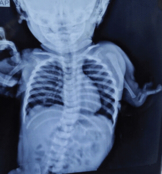 Figure 2: Anteroposterior radiograph of the dorso-lumbar spine and both upper limbs demonstrating multiple skeletal deficiencies.