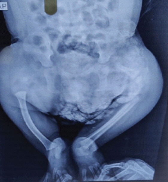 Figure 3: Anteroposterior radiograph of the pelvis and both lower limbs demonstrating multiple skeletal deficiencies.